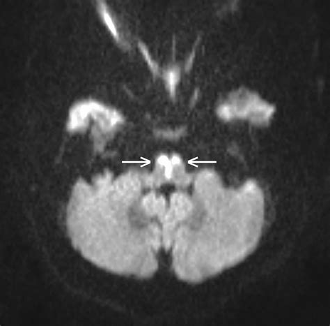 A case of bilateral stroke of the medulla oblongata | Journal of Neurology, Neurosurgery ...
