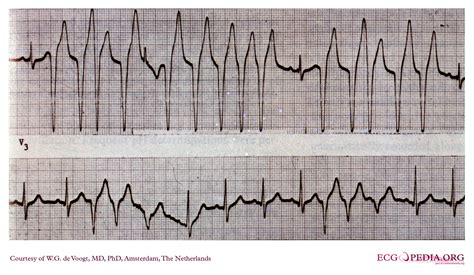 Atrial Fibrillation With Rapid Ventricular Response