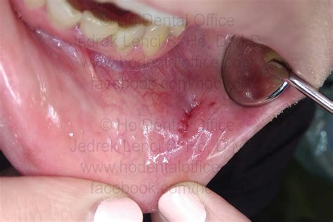 Mucocele excision - surgical removal of a soft tissue lesion | Ho Dental Office | Dentist ...