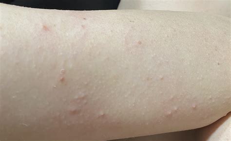 White Bumps On Arms
