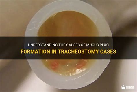 Understanding The Causes Of Mucus Plug Formation In Tracheostomy Cases ...
