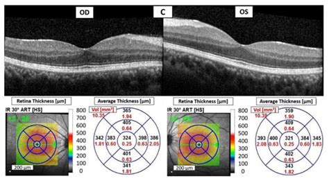 Anterior Uveitis Secondary to Avelumab and Pembrolizumab in a Patient ...