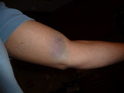 The Bicep Injury