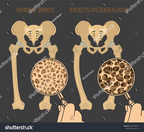 Osteomalacia Vs Osteoporosis