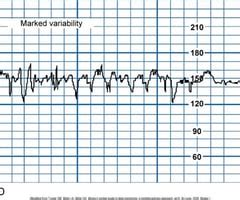 Image result for Absent Variability