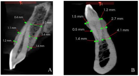 Analysis of the Sagittal Root Position of the Maxillary and Mandibular ...