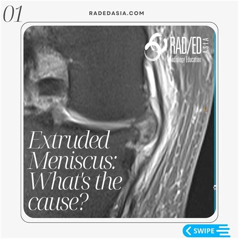 KNEE MRI MENISCUS ROOT TEAR EXTRUSION - Radedasia