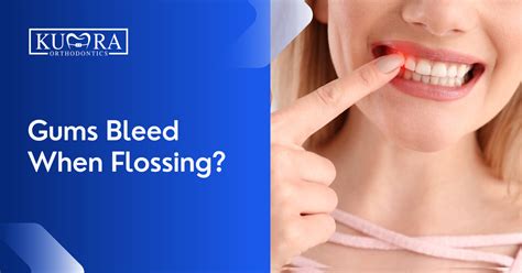 Why Gums Bleed When Flossing: Causes and Remedies | Kumra Orthodontics