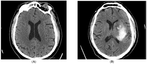Early Hemorrhagic Transformation after Reperfusion Therapy in Patients ...