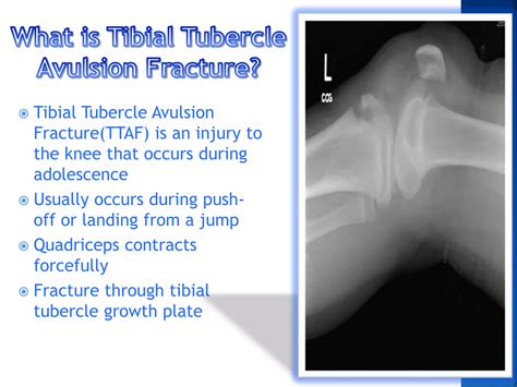 Tibial Tubercle Avulsion Fracture Powerpoint (1) | PPTX