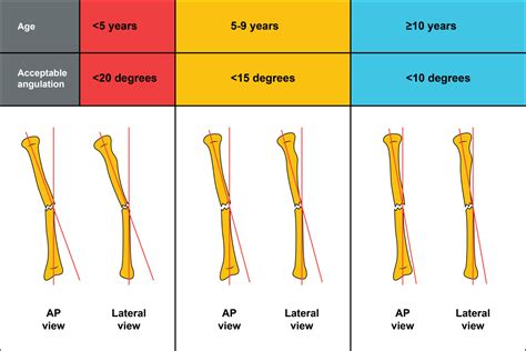 Radius And Ulna Fracture Rehabilitation Protocol at Zoe Walker blog