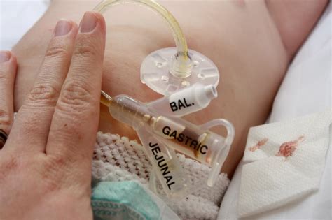 Gastrostomy Week - Devices