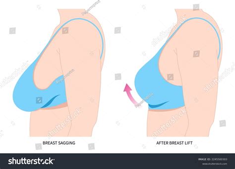 93 Gynecomastia Operation Images, Stock Photos & Vectors | Shutterstock