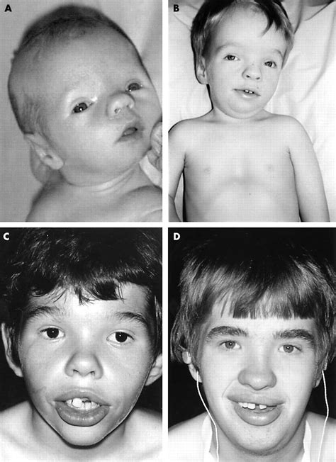 Coffin Lowry Syndrome Pedigree