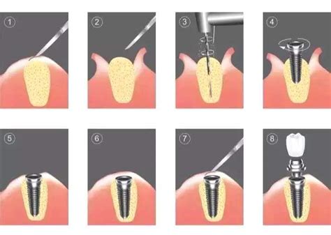 种植牙分为哪几个步骤呢？过程需要多长时间呢？ - 口腔资讯 - 牙齿矫正网