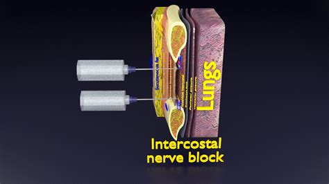 thorax thoracotomy thoracocentesis intercostal nerve block 3D model - Superhive (formerly ...