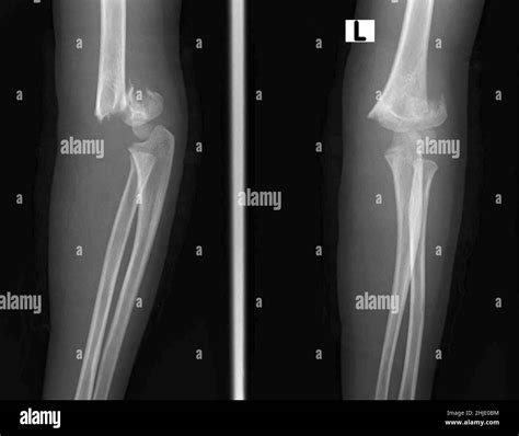 Supracondylar humerus fracture, X-ray Stock Photo - Alamy