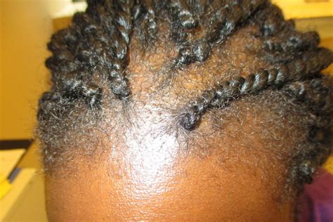 LEARN ABOUT TRACTION ALOPECIA: PREVENTION AND TREATMENT