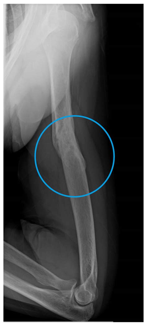 Humerus Fracture Recovery