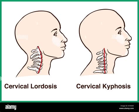 Normal vs. Reversal of Cervical Lordosis Stock Vector Image & Art - Alamy