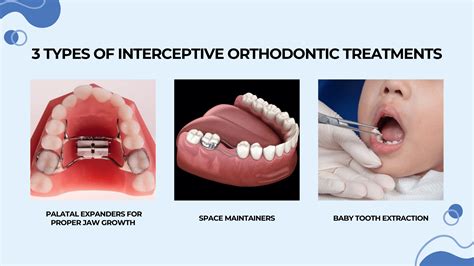 Interceptive Orthodontic Treatment in Hollywood, MD