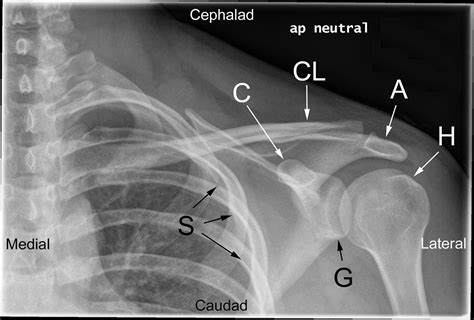 Posterior shoulder dislocations | The BMJ