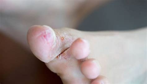 5 Home Remedies To Treat Itchy Feet - lifeberrys.com