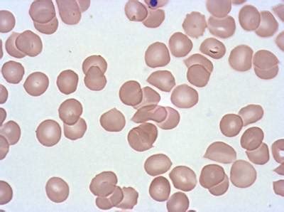 Plasmodium Falciparum from Images of Giemsa for Malaria Detection ...