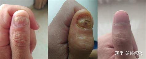 灰指甲的治疗原理是什么？为什么灰指甲难以治愈？ - 知乎
