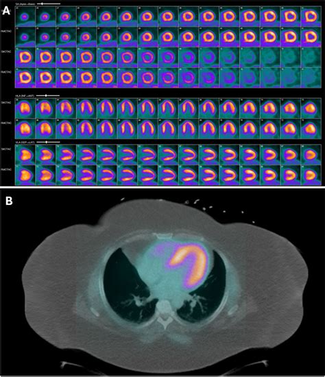 Cardiac positron emission tomography/Computed tomography (PET/CT) in current cardiology ...
