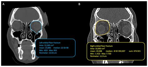 Orbital Floor Fracture Xray