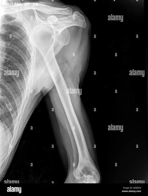 X Ray Pictures Of Dislocated Shoulder at Ruthie Rumsey blog
