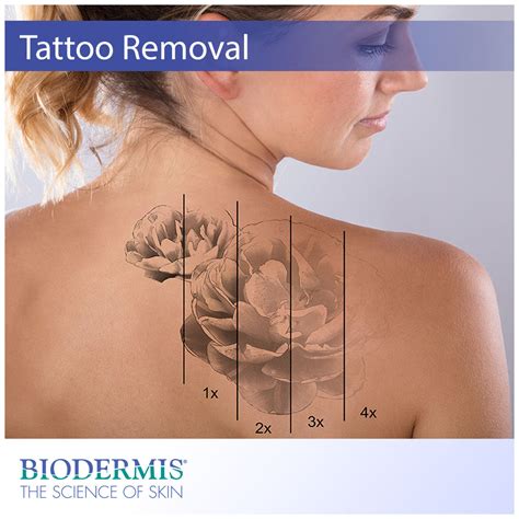 Complete tattoo removal - Bronctattooaus.com