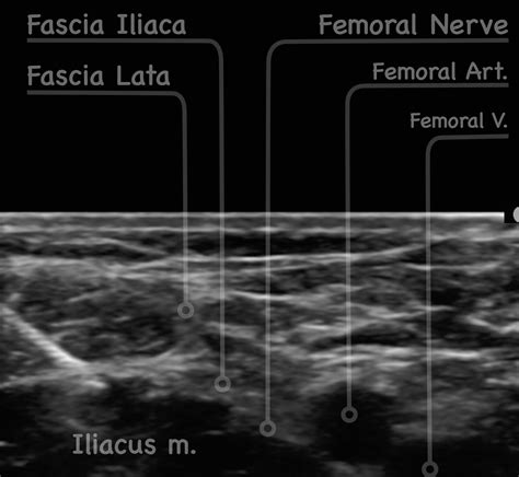 Fascia Iliaca Block – FIB – EMbeds.co.uk
