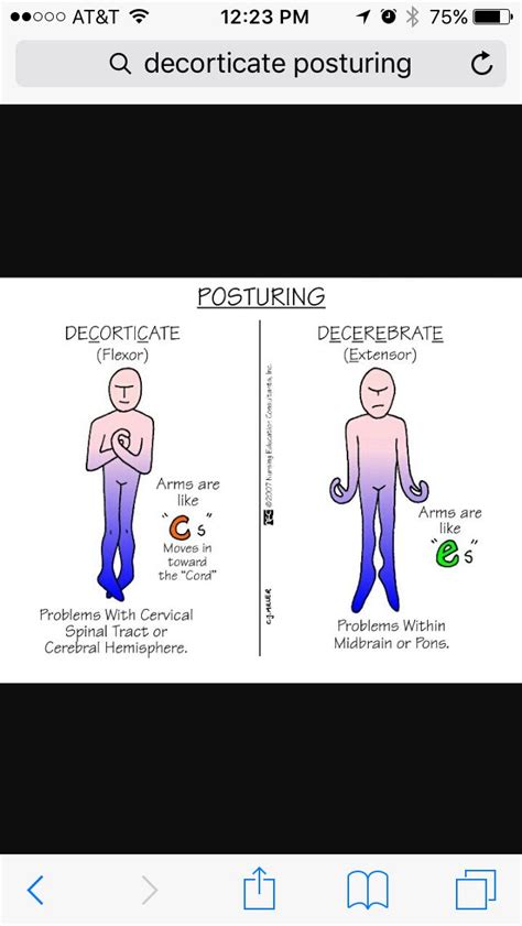 Image result for Decorticate Posture
