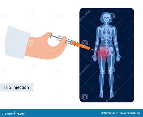 Cortisone Injection For Hip Bursitis at Stacy Goode blog