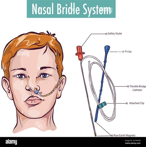 Types Of Nasal Feeding Tube at Angela Lewandowski blog
