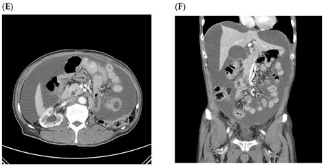 Prevalence and Clinical Implications of Ascites in Gastric Cancer ...