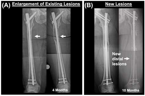 Progression of Femoral Osteolytic Metastases after Intramedullary ...