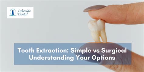 Image result for Basic Tooth Extraction