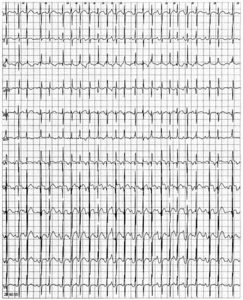 Multifocal Atrial Tachycardia Strip