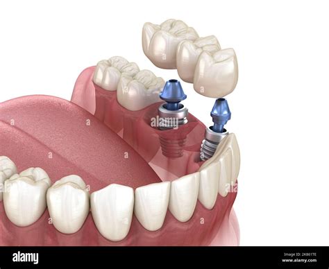 Dental bridge supported by implants. Medically accurate 3D illustration of human teeth and ...
