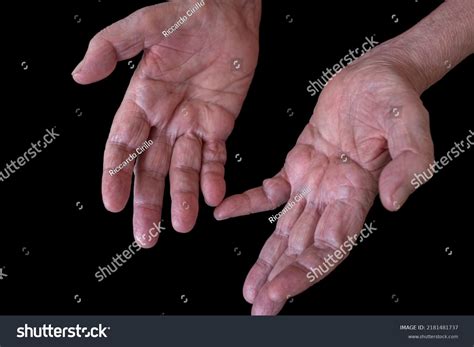 Cidp Disease Life Expectancy