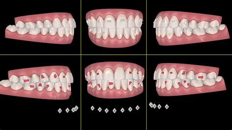 Image result for Invisalign ClinCheck