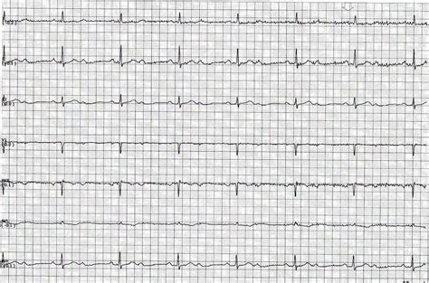 Second Degree Heart Block Type 2 Ecg Findings - Free Word Template