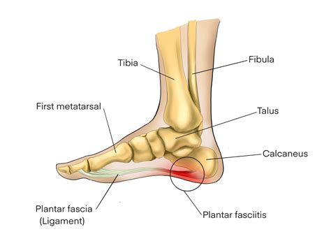 Plantar Fasciitis | Avita Health System