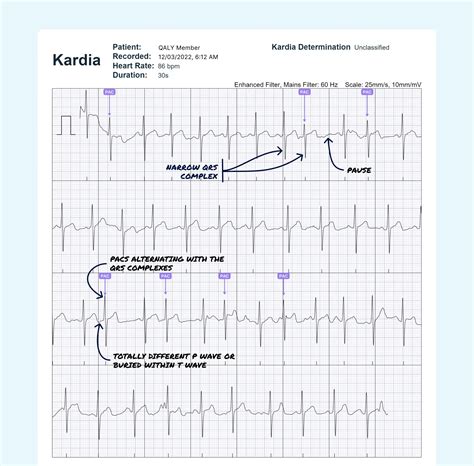 Atrial Bigeminy Vs. Atrial Trigeminy on Your Watch ECG | Qaly