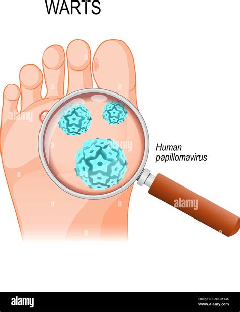 Foot Warts are caused by infection with a type of human papillomavirus. Close-up of HPV Stock ...