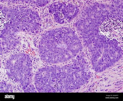 Lung cancer: large cell neuroendocrine carcinoma Stock Photo - Alamy