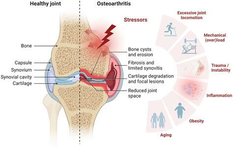 What Affects Osteoarthritis